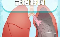 肺纤维化的护理常识