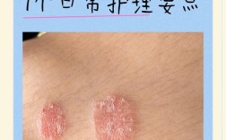 牛皮癣患者如何日常护理？