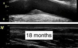B超斑块是什么？如何解读检查结果？