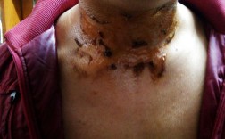 颈部烫伤会损伤神经吗？