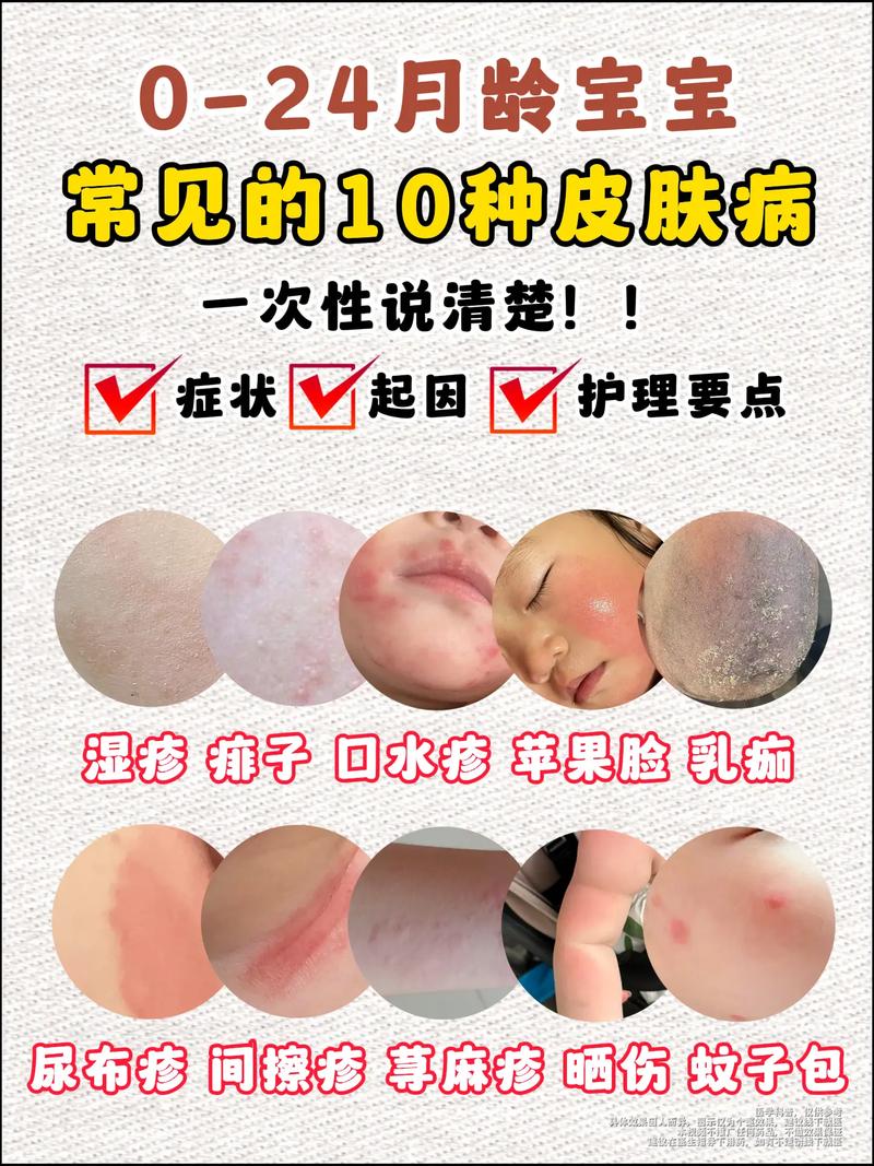 儿童期异位性皮炎常识