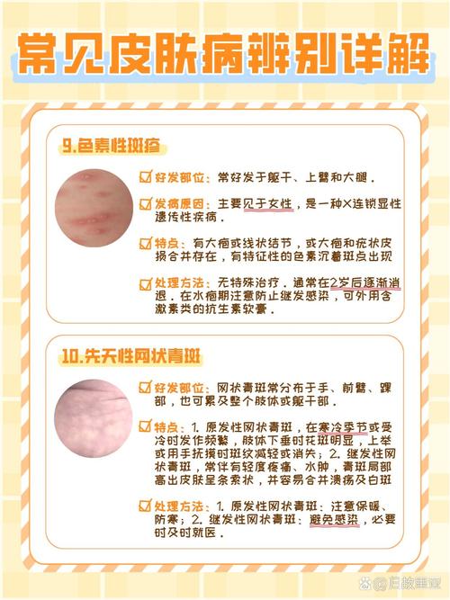 儿童期异位性皮炎常识