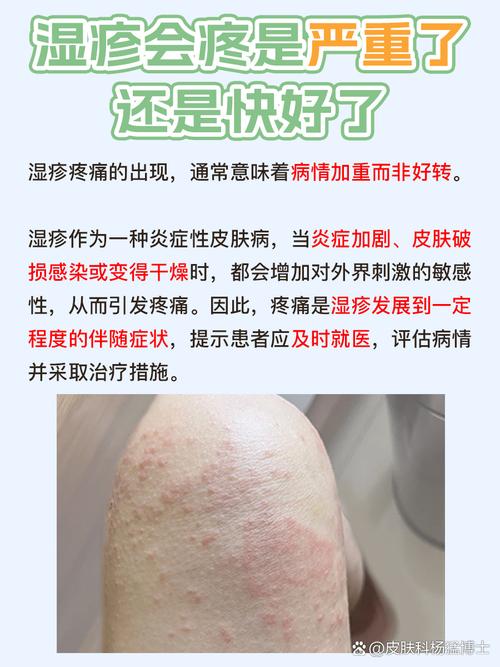传染性湿疹样皮炎常识