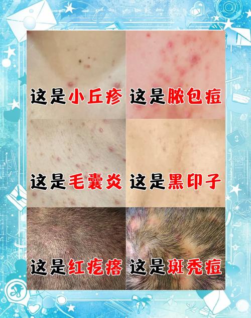 生活常识能治毛囊炎