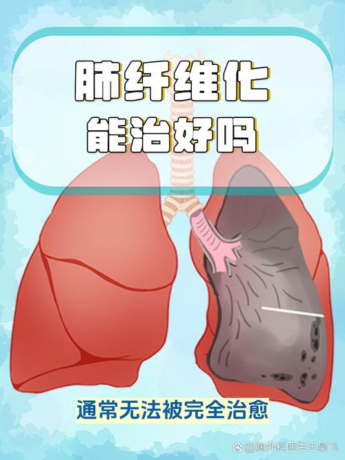 肺纤维化的护理常识