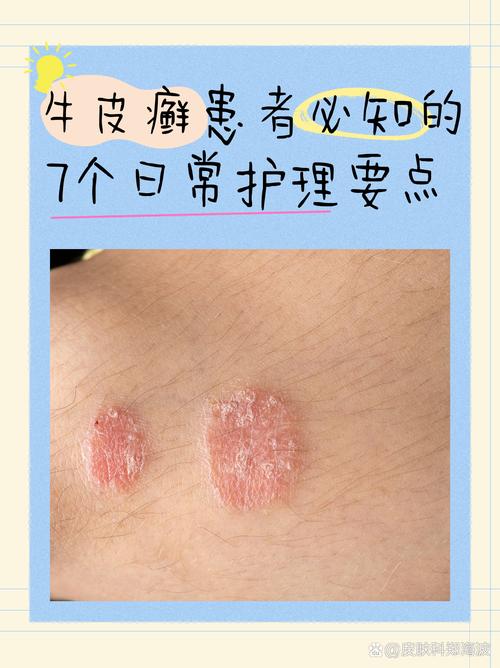 牛皮癣患者生活小常识