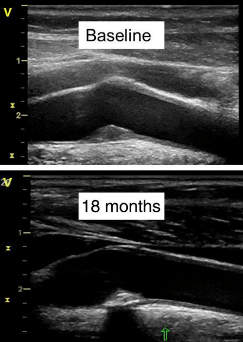 b超斑块的基本小常识