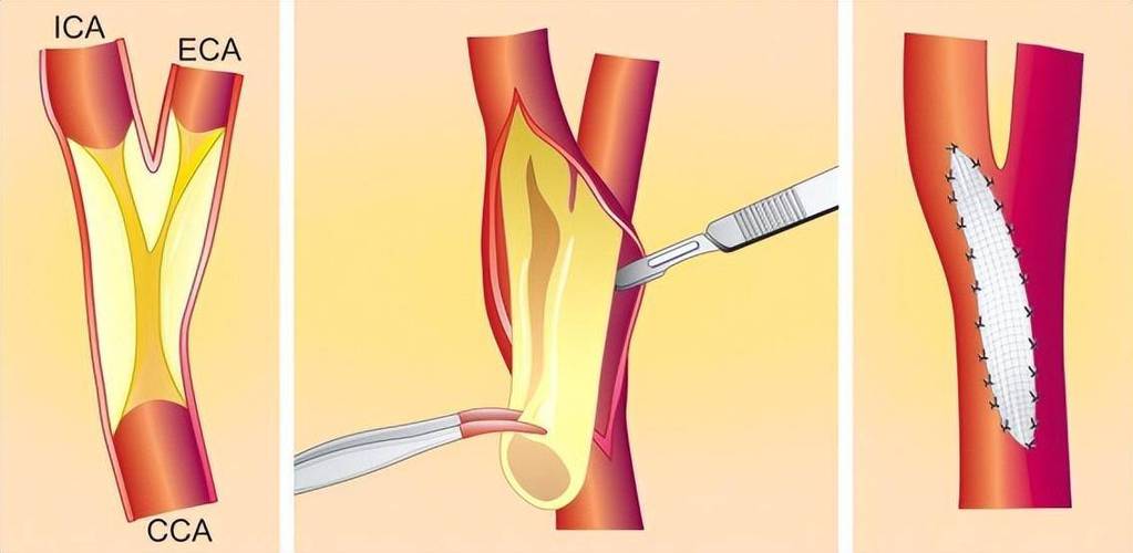b超斑块的基本小常识