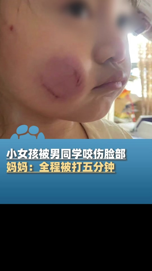 儿童安全教育咬伤