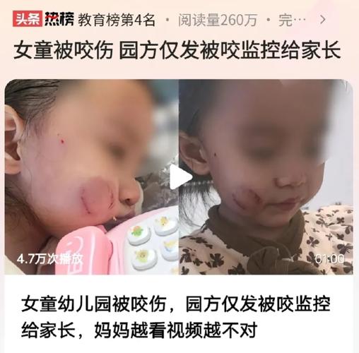 儿童安全教育咬伤