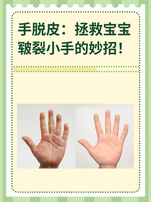 幼儿保护手的基本常识