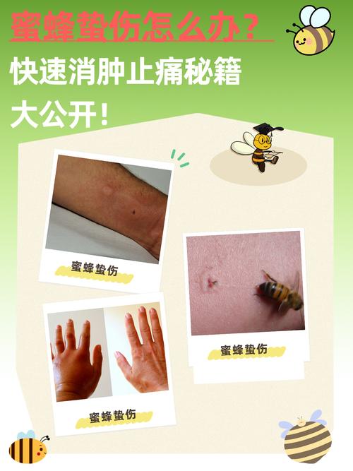 蜂蜇伤急救常识图片