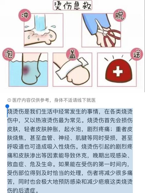 轻微烫伤的临时处理常识