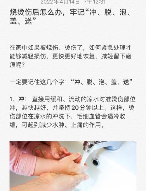 轻微烫伤的临时处理常识