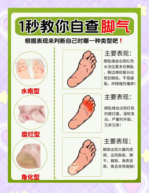 生活小常识巧治脚气