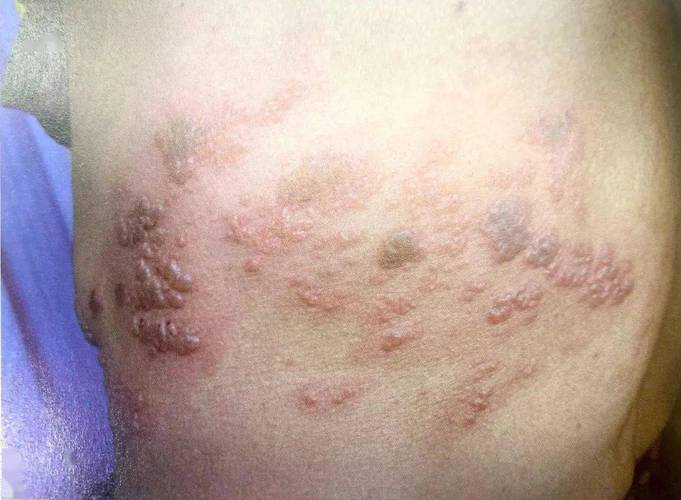 生殖器疱疹小常识