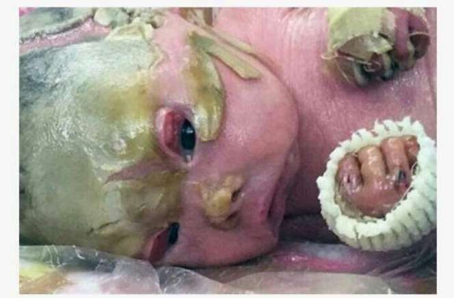 宝宝鱼鳞病的常识