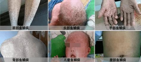 宝宝鱼鳞病的常识