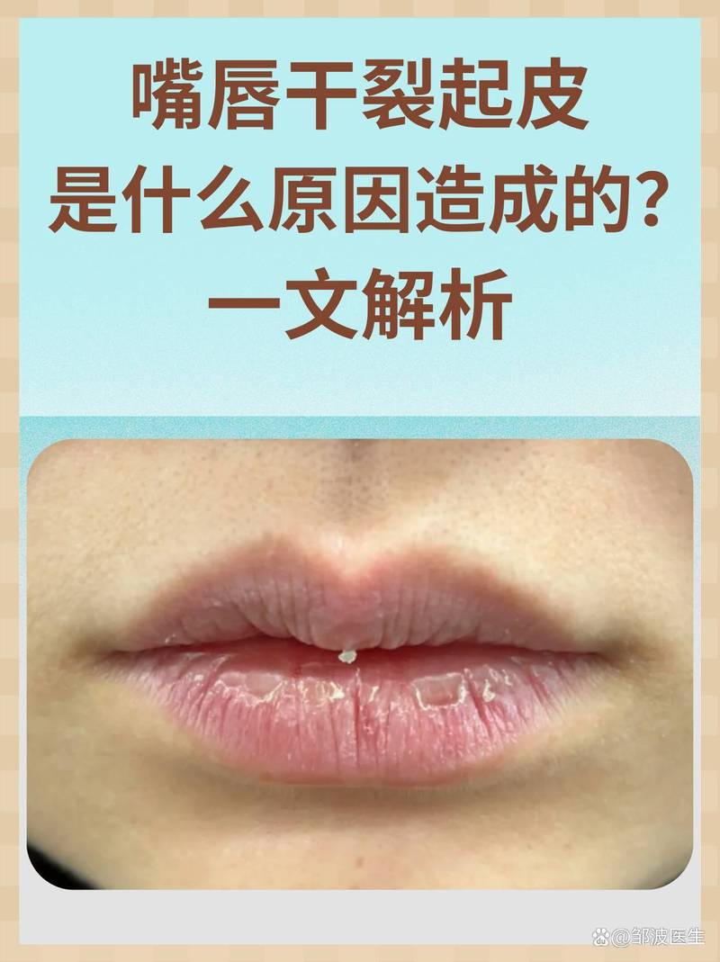 防止嘴唇干裂的小常识