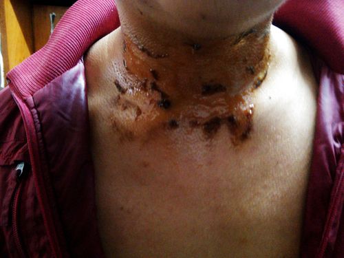 颈部烫伤伤到神经常识