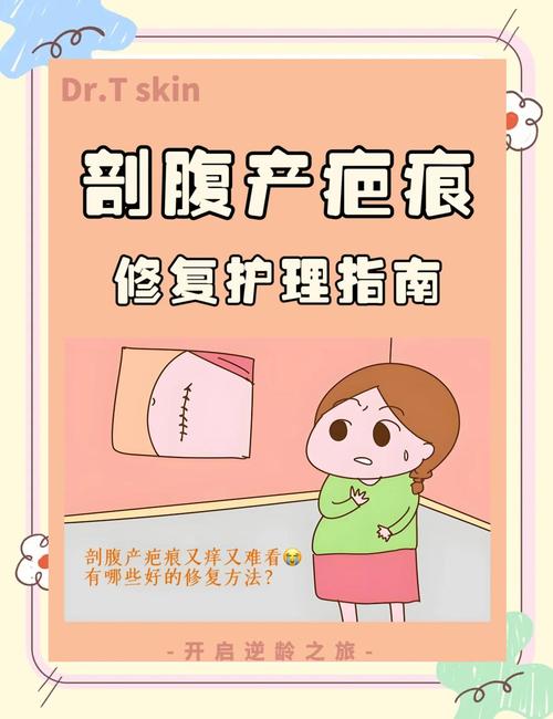 剖腹产妇伤口护理常识